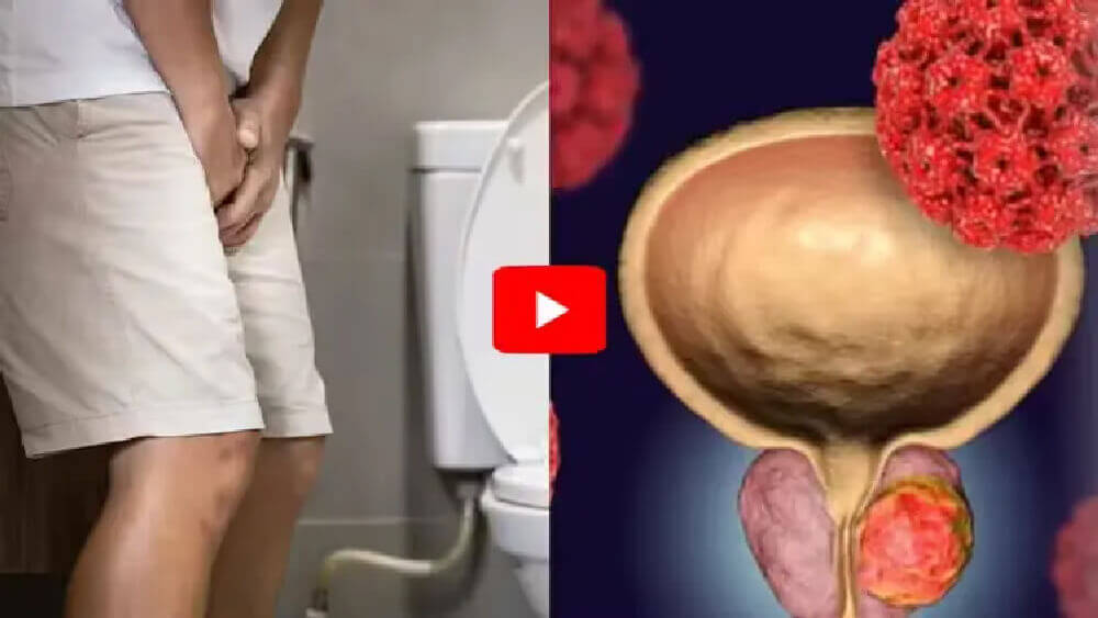 Split image showing a man standing in front of a toilet and a medical illustration of an enlarged prostate