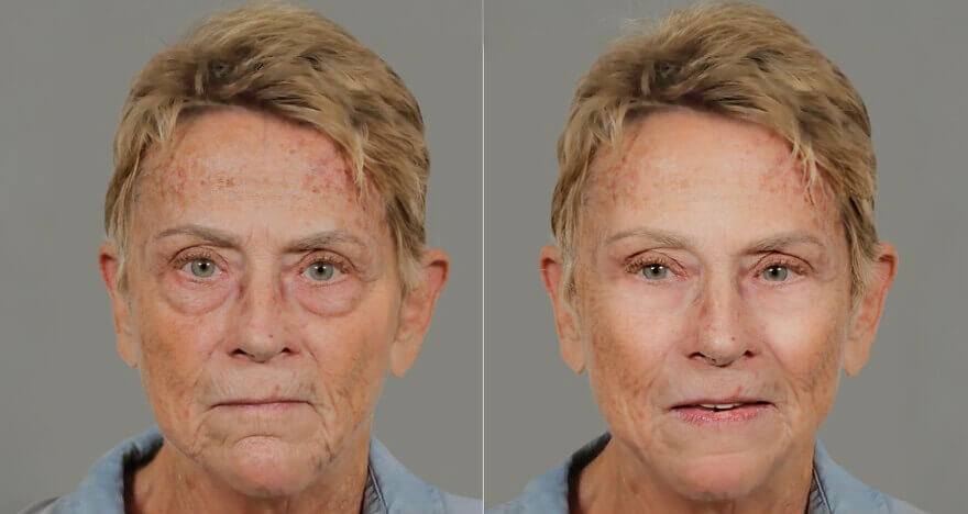 Before and after comparison of a woman's face showing reduced wrinkles and eye bags